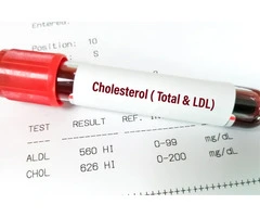 Cholesterol Blood Test in London – Know Your Heart Risk