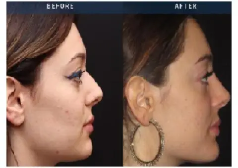Non-surgical Rhinoplasty in Slough | BMACS Clinic