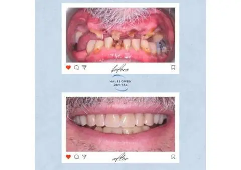 How Can Composite Resin Bonding Teeth Transform Your Appearance?