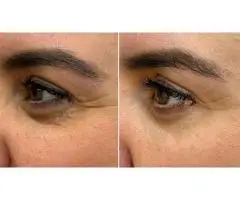 Polynucleotides Treatment in Leeds – Revive Your Skin Naturally
