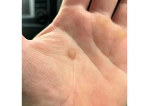 Effective Wart Removal at AH Advanced Skin Specialist