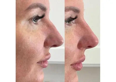 Non-surgical Rhinoplasty in Windsor - Call 02036330332