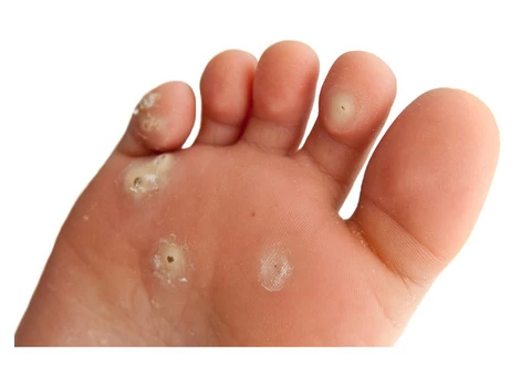 Verruca Treatment & More Information On Verrucas