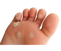 Verruca Treatment & More Information On Verrucas