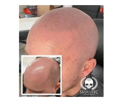 Scalp Micropigmentation (SMP) For Men in London and UK