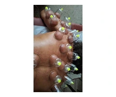Professional Hijama Cupping Therapy Course – Sunnah-Based Practical Training