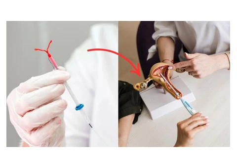 Want to get your coil fitting done by experts in London? - 3/5