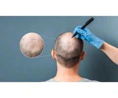 Thinning Hair? Get Natural Results with FUE Hair Transplant – Book Now!