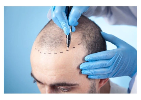 Thinning Hair? Get Natural Results with FUE Hair Transplant – Book Now! - 2/3