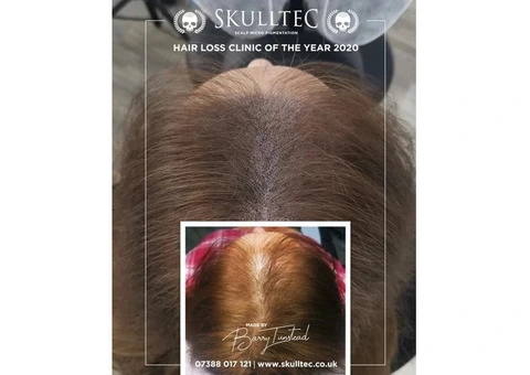 Get Scalp Micropigmentation for Women