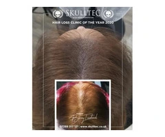 Get Scalp Micropigmentation for Women