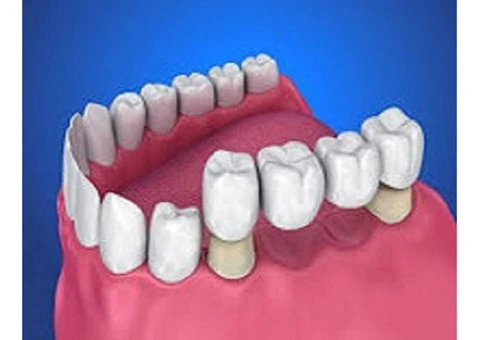 Trusted Composite Dental Fillings for Long-Lasting Protection