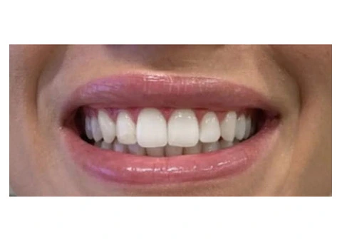 Get Teeth Whitening Services In London By Hermes London Dental Clinic