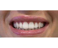 Get Teeth Whitening Services In London By Hermes London Dental Clinic