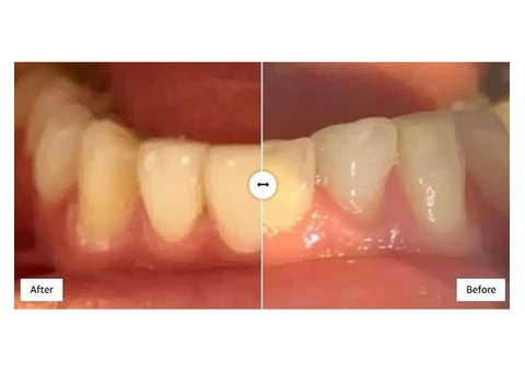 Tooth Bonding | London Bonding Treatments | By Hermes London Dental Clinic