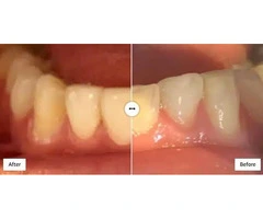 Tooth Bonding | London Bonding Treatments | By Hermes London Dental Clinic