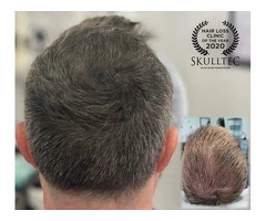 Scalp micropigmentation For Men