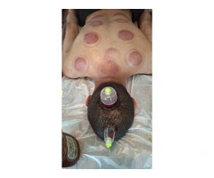 Beginner to Advanced Hijama Cupping Therapy Course