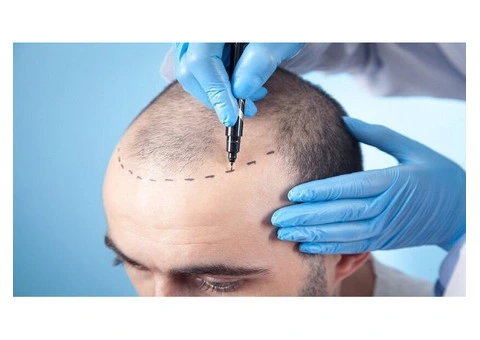 Regain Your Confidence with the Best Hair Transplant Clinic in the UK!