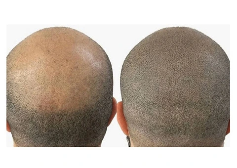 Hair Pigmentation Treatment | Micropigmentation For Hair