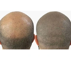 Hair Pigmentation Treatment | Micropigmentation For Hair