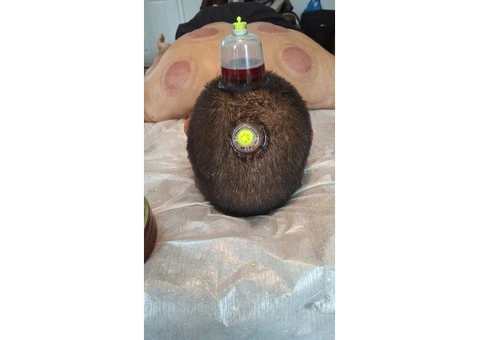 Hijama Training Course in London - 3/3