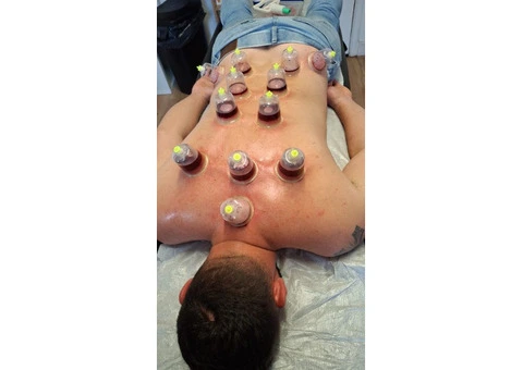 Professional Hijama Cupping Training Course in London - 1/3