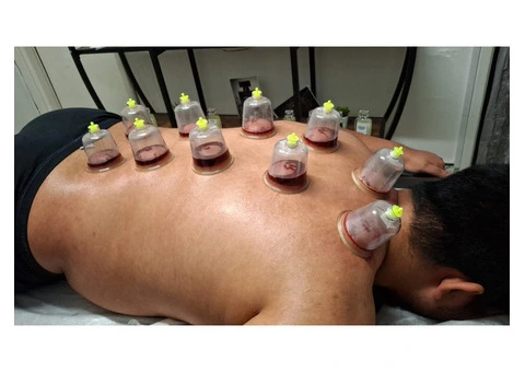 Certified Hijama Cupping Therapy Training - 2/3