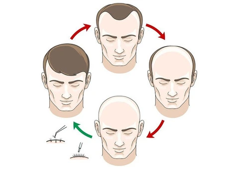 Get Your Hair & Confidence Back – UK’s Best Hair Transplant Clinic!