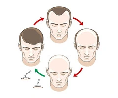 Get Your Hair & Confidence Back – UK’s Best Hair Transplant Clinic!