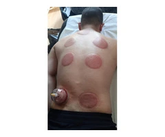 Complete Hijama Training: From Basics to Professional Level