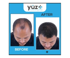 Hair treatment Leicester