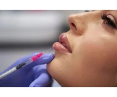 Expert Lip Augmentation in London for Natural Look