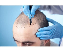Get Your Best Hair Back: FUE Hair Transplants in the UK & Turkey