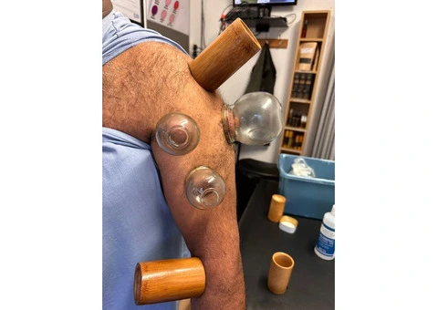 Hijama Cupping Diploma Course – UK Accredited Training - 1/3