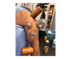Hijama Cupping Diploma Course – UK Accredited Training