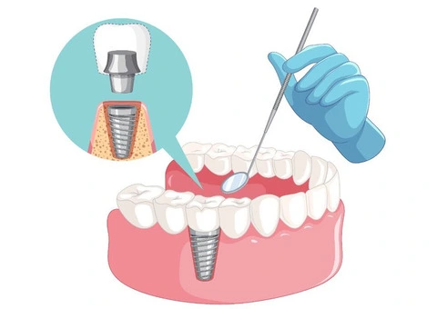 Navigating Dental Implants in London: Finding the Right Specialist for You