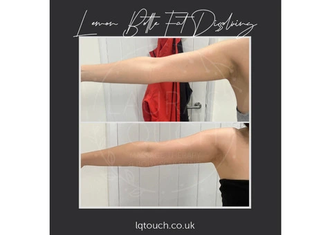 Say Goodbye to Stubborn Fat: Fat Dissolving in Bromley Explained