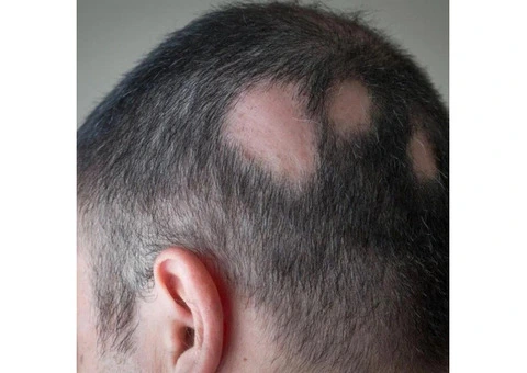 Hormonal Hair Loss Solution In Scotland