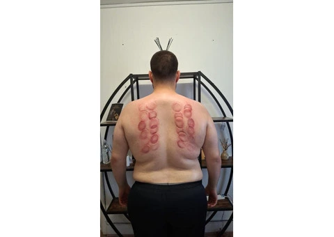 Start Your Journey with Hijama Cupping Therapy! ✨ - 1/3
