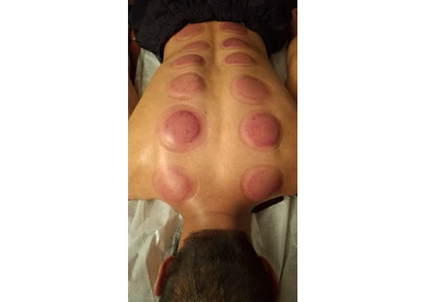 Accredited Hijama Cupping Training Academy in the UK - 1/3