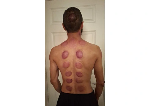Accredited Hijama Cupping Training Academy in the UK - 3/3