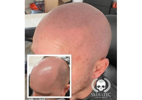 How to Get the Best Scalp Micropigmentation Results