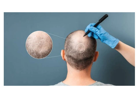 Get the Best Hair Transplant in the UK – Book Your Appointment Today! - 1/7