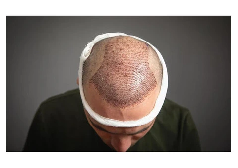 Get the Best Hair Transplant in the UK – Book Your Appointment Today! - 2/7