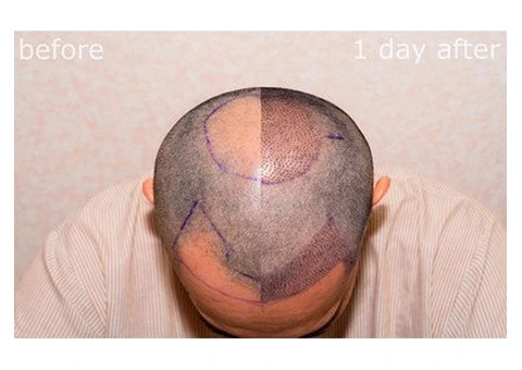 Get the Best Hair Transplant in the UK – Book Your Appointment Today! - 3/7