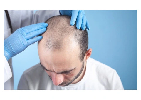 Get the Best Hair Transplant in the UK – Book Your Appointment Today! - 4/7
