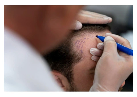 Get the Best Hair Transplant in the UK – Book Your Appointment Today! - 6/7