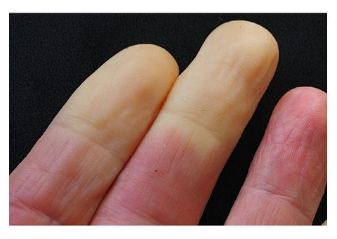 Vibration White Finger Claims - Expert Legal Support in Bolton