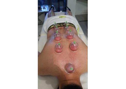 Revive Your Health with Hijama (Cupping Therapy) - 1/3